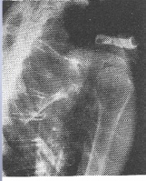 Radiografía Transtorácica